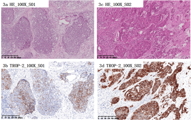  迈杰转化医学检测的两例三阴性乳腺癌组织的HE 、TROP-2 IHC染色结果图