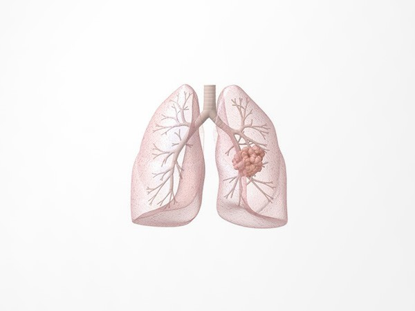 肺癌检测